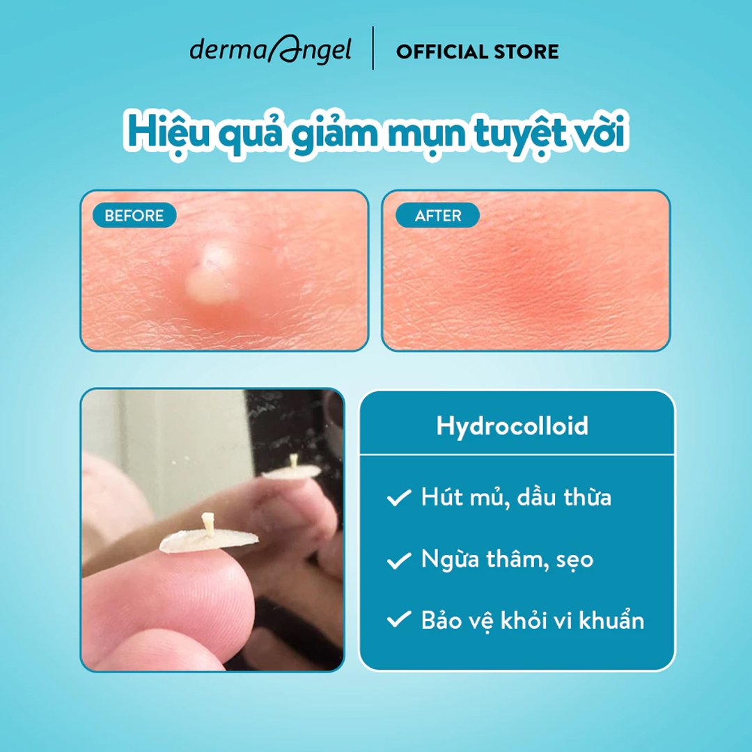 Combo 2 Miếng Dán Mụn Derma Angel Dùng Cho Ngày & Đêm 18 Miếng
