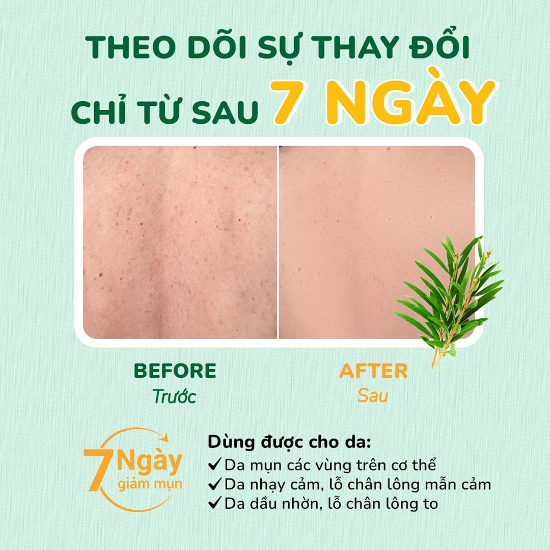 Sữa Tắm Neoskin Giảm Mụn Lưng Chiết Xuất Tràm Trà 250ml